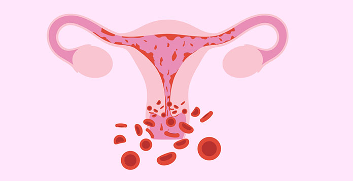 Heavy Menstrual Bleeding