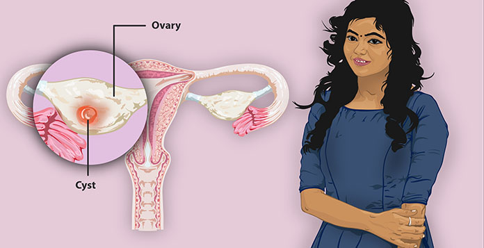 Ovarian Cysts  in Lucknow