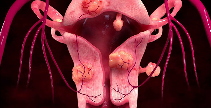 Uterine Fibroids